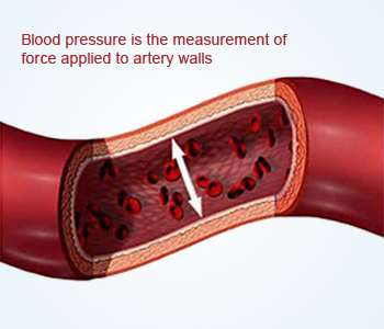 Hypertension